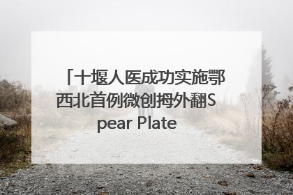 十堰人医成功实施鄂西北首例微创拇外翻Spear Plate髓内板矫形术